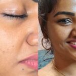 Shalu Shammu Instagram - I did my Face MesoTherapy with GFC in my @suhaacosmeticclinic 😍 Finally would Love to reveal my skincare routine 😇 • I like to do this treatment from time to time to keep my skin smooth, even, get rid of pores and fine lines. -After a week I see amazing results and they keep improving over the next few months. -The first couple days skin is red and peeling off a little, bringing out that “baby skin” It’s important to be patient with the down time process which doesn’t take longer than 7-10 days. -So besides having a skin care routine at home this is one of my secrets to keep my skin glowy and healthy throughout work, traveling, sun exposure, pollution etc. Ps : ll show you on stories how my skin is looking after the 10th day… Book Your Appointment Today & Contact Us: 📞 - +91 8925723337 🌐 - WWW.SUHAACOSMETICCLINIC.COM #suhaamultispecialitycosmeticclinic #suhaacosmeticclinic #suhaaclinic #suhaa #shalushamu #shalushamuvlogs #prptreatment #mesotherapy #plasma #infusion #getreadywithme Suhaa Multispeciality Cosmetic Clinic