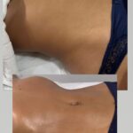 Nathalia Kaur Instagram - A função da drenagem linfática é retirar a linfa que fica acumulada entre as células, o que pode ser ocasionado por um retardo da pessoa na produção da linfa, por exemplo, ou por dificuldades da absorção por parte das células. Com essa estimulação, há a diminuição do inchaço e melhora da celulite. O procedimento melhora também a circulação em geral, relaxa o corpo e pode atuar discretamente no combate a gordura localizada - uma vez que a massagem aumenta o metabolismo do local. O transporte de gordura - principalmente na forma de triglicerídeos - e vitaminas é feito pela linfa do intestino e desemboca no fígado sendo metabolizado e mandando ao sistema circulatório os nutriente e volume sanguíneo de maneira balanceada. Por isso, quando há uma melhora da circulação da linfa, há também uma maior oxigenação dos tecidos do corpo, o que melhora o aspecto da celulite e gordura localizada. Mas não se iluda, a drenagem linfática não emagrece por si só! Ela vai ajudar a reduzir medidas por acabar com o inchaço e eliminar toxinas do corpo. Mas para obter resultados mais efetivos será necessário abordar hábitos saudáveis, como uma alimentação balanceada e prática de exercícios físicos. ☺️❤️ #drenagem #saude #esteticacorporal #esteticafacial #niteroi #rj Niterói, Rio de Janeiro, Brazil