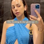 Nitibha Kaul Instagram - Simply healing acne is not enough. Post acne skin comes with a lot of trauma- bumps, redness, scars, enlarged pores & uneven skin texture. Thats why this phase was crucial in ensuring my skin looks the way it is today. Its a slow process, probably slower than healing the acne itself, but if treatments are taken at the right time along with following a good & consistent routine + basic lifestyle changes- YOU CAN GET YOUR SKIN BACK ♥️ If I can, so can you. All my treatments were done at @potenzawellness by @drjayapathakofficial & at @medlinksaesthetics by @drpankajchaturvedi_md (not sponsored)