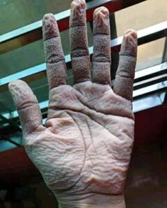 Shirish Sharavanan Instagram - This is the hand of a doctor after removing his medical precautionary suit and gloves after 10 hours of duty.
Salute to the frontline heroes.👍🙏 #covid19 #lockdown #chennai