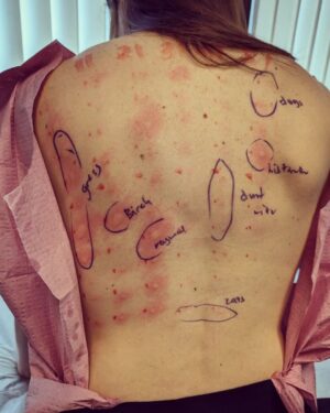 Alison Haislip Instagram - WARNING: Swipe ONLY if you want to see how allergic I am to the outdoors.

Turns out, I'm allergic to basically all trees and grass. And while I've always had mild allergies, the ungodly rain SoCal had at the beginning of the year has triggered an allergy in me like I have never known...I have absolutely NO sinus issues, but if I don't take an antihistamine every other day, I break out in hives. It's insane.

So if @zyrtecallergy is looking to sponsor someone this allergy season, I'd love to throw my hat in the ring. 

(Oh and don't worry about that tiny circle that says dogs up in the corner. That's only a mild allergy. Thankfully I can still snuggle all doggos.)