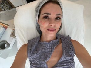 Dafne Fernández Instagram - Os cuento uno de mis trucos de belleza estrella, el Ultherapy! @clinicamiracueto 
Es lo que nos hacemos muchas actrices ya que es ideal para acompañar al envejecimiento porque reafirma y redefine el óvalo facial. 

Decimos que es un tratamiento que actúa como un LIFTING SIN CIRUGIA de forma realmente efectiva y con resultados naturales. Indicado para todo tipo de pieles, sin una edad determinada. Resultados en una sola sesión.
Pero van mejorando notablemente entre los 90 y 180 días después de la sesión.

En el tratamiento se emplean ultrasonidos focalizados y selectivos de alta precisión para producir un calor controlado entre 65 y 70°C en puntos muy determinados, consiguiendo una retracción dérmica inmediata, con resultados que se aprecian de manera evidente.

Yo me lo hago una vez al año y ya llevo 3 haciéndomelo. Lo amo!!

Como siempre yo confío en las mejores manos @dra.anacrespo 
En @clinicamiracueto 
Os dejo El Paso a paso en mis stories!