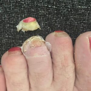 Eddie Izzard Instagram - Almost 36 miles run so far today on 'double marathon Sunday'. And with a toe that looks like this... #MakeHumanityGreatAgain eddieizzard.com - The Beekeepers