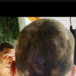 Jordan Haj Instagram - Ze 100% zarostlá ALOPECIE zítra 13:30 Q&A a livestream s Dr. Která mi to vyléčila. O léčbě co jsem absolvoval já, o tom jestli je to jistota, když to zkusíš léčit stejně, a o dalších možnostech léčby. Už delší dobu mi denodenně chodí dotazy na téma alopecie a já se snažím odpovídat svemdomitě ale vlastně na většinu otázek eridované odpovědi samozřejmě nemám. Budu zítra (neboli dnes, v pondělí 19.6.) Na kontrole u paní doktorkorky @monika_arenbergerova ve vinohradské nemocnici a poprosil jsem ji, jestli by se mnou neudělala livestream ke kterému by se mohli připojit ti, co mi píší dotazy a dostat odpovědi připmo od ní. zkusím to tu pak uložit s co nejobsáhlejším pokrytím toho jak jsem to k současnému úspěchu(snad na co nejdéle trvajícímu) absolvoval pod jejím dozorem a péčí já.