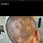 Jordan Haj Instagram - Ze 100% zarostlá ALOPECIE zítra 13:30 Q&A a livestream s Dr. Která mi to vyléčila. O léčbě co jsem absolvoval já, o tom jestli je to jistota, když to zkusíš léčit stejně, a o dalších možnostech léčby. Už delší dobu mi denodenně chodí dotazy na téma alopecie a já se snažím odpovídat svemdomitě ale vlastně na většinu otázek eridované odpovědi samozřejmě nemám. Budu zítra (neboli dnes, v pondělí 19.6.) Na kontrole u paní doktorkorky @monika_arenbergerova ve vinohradské nemocnici a poprosil jsem ji, jestli by se mnou neudělala livestream ke kterému by se mohli připojit ti, co mi píší dotazy a dostat odpovědi připmo od ní. zkusím to tu pak uložit s co nejobsáhlejším pokrytím toho jak jsem to k současnému úspěchu(snad na co nejdéle trvajícímu) absolvoval pod jejím dozorem a péčí já.