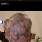 Jordan Haj Instagram - Ze 100% zarostlá ALOPECIE zítra 13:30 Q&A a livestream s Dr. Která mi to vyléčila. O léčbě co jsem absolvoval já, o tom jestli je to jistota, když to zkusíš léčit stejně, a o dalších možnostech léčby. Už delší dobu mi denodenně chodí dotazy na téma alopecie a já se snažím odpovídat svemdomitě ale vlastně na většinu otázek eridované odpovědi samozřejmě nemám. Budu zítra (neboli dnes, v pondělí 19.6.) Na kontrole u paní doktorkorky @monika_arenbergerova ve vinohradské nemocnici a poprosil jsem ji, jestli by se mnou neudělala livestream ke kterému by se mohli připojit ti, co mi píší dotazy a dostat odpovědi připmo od ní. zkusím to tu pak uložit s co nejobsáhlejším pokrytím toho jak jsem to k současnému úspěchu(snad na co nejdéle trvajícímu) absolvoval pod jejím dozorem a péčí já.