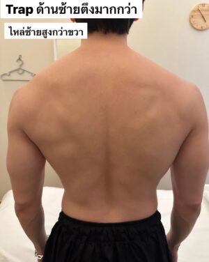 Kittipat Samantrakulchai Instagram - เวลาเมื่อยๆเข้าร้านนวดก็จะดีขึ้นอยู่ 2-3 วัน ก็กลับมาเป็นเหมือนเดิม เลยตัดสินใจมาลองหาหมอกายภาพ @bpcphysio คือ ดีย์ คุณหมอให้คำปรึกษา แนะนำ ดีมาก ได้ความรู้จากคุณหมอไปใช้เยอะเลย

👇How to ลาขาดอาการปวด👇
Step แรก คือเราต้องรู้สาเหตุของอาการ เช่น พฤติกรรมของเราที่ใช้ในชีวิตประจำวัน อย่างบิวเป็นคนชอบนอนดูทีวีบนเตียงด้วยหมอนสูง ก็เลยเป็นคนคอยื่น ปวดเมื่อยบ่า
Step 2 เมื่อเรารู้สาเหตุเราก็แก้ไขให้ตรงจุดและปรับพฤติกรรม
Step 3 ออกกำลังกายเพิ่มความแข็งแรงให้กับกล้ามเนื้อที่เกี่ยวข้องและยืดกล้ามเนื้อที่มีการตึงตัวอยู่เป็นประจำ

@bpcphysio
#BestPhysiotherapy