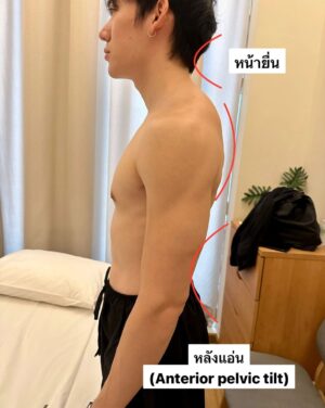 Kittipat Samantrakulchai Instagram - เวลาเมื่อยๆเข้าร้านนวดก็จะดีขึ้นอยู่ 2-3 วัน ก็กลับมาเป็นเหมือนเดิม เลยตัดสินใจมาลองหาหมอกายภาพ @bpcphysio คือ ดีย์ คุณหมอให้คำปรึกษา แนะนำ ดีมาก ได้ความรู้จากคุณหมอไปใช้เยอะเลย

👇How to ลาขาดอาการปวด👇
Step แรก คือเราต้องรู้สาเหตุของอาการ เช่น พฤติกรรมของเราที่ใช้ในชีวิตประจำวัน อย่างบิวเป็นคนชอบนอนดูทีวีบนเตียงด้วยหมอนสูง ก็เลยเป็นคนคอยื่น ปวดเมื่อยบ่า
Step 2 เมื่อเรารู้สาเหตุเราก็แก้ไขให้ตรงจุดและปรับพฤติกรรม
Step 3 ออกกำลังกายเพิ่มความแข็งแรงให้กับกล้ามเนื้อที่เกี่ยวข้องและยืดกล้ามเนื้อที่มีการตึงตัวอยู่เป็นประจำ

@bpcphysio
#BestPhysiotherapy