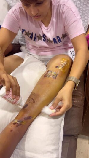 Nisha Rawal Instagram - ♥️
For all the healing wishes coming my way through comments, DMs, prayers, visits from loved ones, friends and family…#Gratitude is all I feel ❤️‍🩹

Update on my recovery from the accident where I had multiple fractures on my left leg, followed by surgery where a rod was implanted from my knee to my ankle!

I am taking good care of myself!

The swelling & pain both are better by 75% and the scans that are being done to track the progress of my bones, are positive!

Painkillers have been considerably reduced and my drowsiness has gone!

I walk with the walker and can’t put weight on my fractured leg yet but, soon I will be wheelchair bound and then there’s no stopping me! I can then go to the mall, coffee shop, salon and take Kavish out for his weekends!

I have also started working on my YouTube channel slowly, picking from where I left, although plans have changed but what is life without a few improvisations and tweaks!

Today I feel better, tomorrow I shall feel stronger & then together we shall #SpreadTheLove ♥️

A BIG bear hug to each of my well-wishers!

And for those who feel this is “KARMA” I am glad, I am paying it off with grace!

My faith is unshakeable in HIM 🙏
.
.
.
.
#NishaRawalReels
#NishaRawal
#PostOpRecovery
#GodIsKind
#KarmaIsAnAwesomeThing
#TibialFractureRecovery
