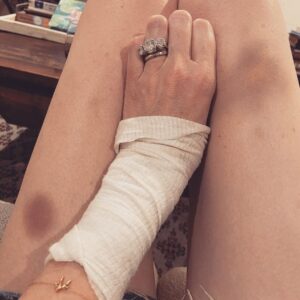 Rachel Nichols Instagram - I’m doing great. Great! “Burns and bruises” - that’s my middle name. I have been a clumsy klutz since birth, so…why quit now? 😂.