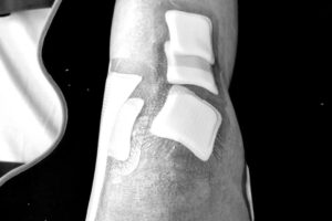 Zlatan Ibrahimović Instagram - For the past six months I played without an ACL in my left knee.
Swollen knee for six months.
I was only able to train with the team 10 times in the last six months.
Took more than 20 injections in six months.
Emptied the knee once a week for six months.
Painkillers every day for six months.
Barely slept for six months because of the pain.
Never suffered so much on and off the pitch.
I made something impossible to something possible.
In my mind I had only one objective, to make my teammates and coach champions of Italy because I made them a promise.
Today I have a new ACL and another trophy