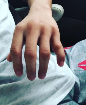 Andre Soukhamthath Instagram - Seeing this injury is bringing me back because this also happened to me. And the crazy part is it was around the exact same time in 2019!!! @rosenamajunas I feel you and props to you for finishing the fight. While someone else is trying to take your head off, you Can’t grip, can’t punch, can’t block, and it’s so painful.