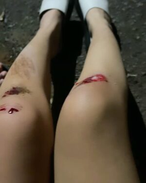 Brisia Jodie Instagram - Jadi ceritanya ya gitu deh intinya panik kengebutan naik otoped listrik gt berdua. Jd emg udah rada error juga remnya dan segala macem. Gak nyangka bakal ngebut bgt tuh otoped, nah pas belokan tuh kayak ga belok malah makin kenceng trus depan udah tiang makanya drpd aku nabrak tiang aku loncat aja kerumput. Jadi gasnya tuh gabisa diberentiin gitu. Tp akhirnya yg jatuh kerumput cuma setengah, sisanya ke aspal. Aku lgsg nutup muka trus yaudah nyungsep deh. Bersyukur masih hidup&sehat walaupun pas dikasih betadine cina mau mati rasanya, tp kita baik2 aja kok! Lebih mikirin ke bekasnya aja sih:’) TAPI MENGAPA KITA KURANG KERJAAN YA JUL @julianjacs