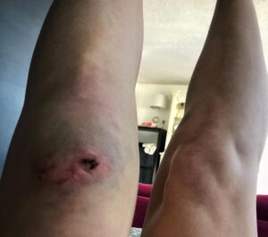 Chelsey Reist Instagram - attempting to jump a four foot gravel road skiing down a mountain at max speed sometimes ends with tiny doggies, tensors and tequila. 
it also sometimes ends in the middle splits with your body somersaulting through your legs...so i hear 😂

i definitely support safe skiing and i also support taking risks; genuinely feel pumped and proud of myself for attempting this trick with gusto. looking forward to icing this down quickly, would be a win to land it before the #skiseason is over. (check out our janky tensor job with a ski strap😂) #adrenalinerush #reistmode #beastmode #nomakeup #nocares and thanks to the fan who bought me this dope toque— told ya i couldn’t wait to wear it!
#whistlerdreamgetaway