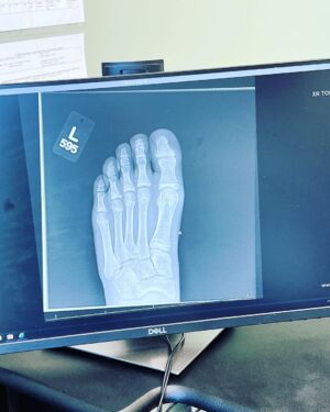 Griffin Wallace Henkel Instagram - #Broken toe in #two places