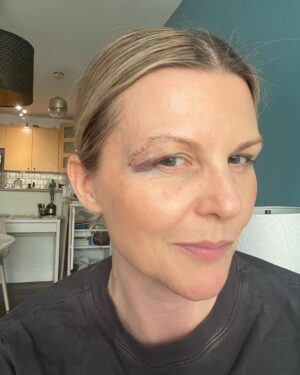 Jennifer Robertson Instagram - A lot of you have been asking for an “eye update” so…first pic is today, second pic is a day after I tried to water a hanging plant.  It’s healed nicely thanks to a brilliant and kind plastic surgeon who re-did my ER stitches less than 24 hours after my fall.  ALSO apparently there is challenge this week to post unfiltered pictures of yourself so both of these are unfiltered like a menthol.