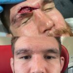 Johnny Eblen Instagram - Hatchet wound update.. still beautiful 😘 healing like wolverine in this bish! Somewhere in Europe