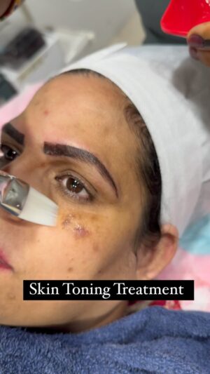 Karate Kalyani Padala Instagram - Thank u so much @karatekalyani garu for choosing us for Skin Toning session 

Budget friendly Offers available with us are below 

1. Hair reduction 
Select any 2 parts (upperlip)(side locks)(chin)(lower lip)999/- per sitting
2. under arm laser per sitting only for 999/-
3.  Full face laser per sitting only for 3500/-
4. full hands full legs underarms 6 sittings 29999/-
5. full body laser 6 sittings only for 44999/-
6. tatto removing per inch per sitting for 399/-
7. Party peel for 999/-
8. Hydra facial 1999/-
9. glowup session  4999/-
10. carbon peel facial 1999/-
11. Skin toning session 4999/-

For appointment reach us on 7799825558

Branches

Kondapur branch: https://maps.app.goo.gl/sadczyMyr7NePNkb7?g_st=ic

KPHB Branch: https://maps.app.goo.gl/gwM9wnnCrytmgNe58?g_st=ic