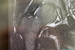 Paul Felder Instagram - Some bad news this week. Anyone close to me knows that I’ve had some hip issues for years. I have been kicking/doing martial arts since I was a 12 year old boy and all of that kicking and rotating has taken a big toll. After a hard bike and run this week I woke up in some serious discomfort, had livery little range of motion in my right hip. I reached out to Heather and Dr D with the ufc to help set up an mri (finally) long story short…I have the hips of an 80 year old man. I have no soft tissue left and am grinding bone on bone. I don’t know what’s next! I have to speak with some specialists and find out. I am pretty sure my season of racing is over. I just truly hope this ain’t the end. For now time to focus on family time and work!