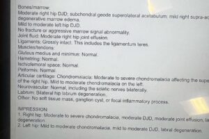 Paul Felder Instagram - Some bad news this week. Anyone close to me knows that I’ve had some hip issues for years. I have been kicking/doing martial arts since I was a 12 year old boy and all of that kicking and rotating has taken a big toll. After a hard bike and run this week I woke up in some serious discomfort, had livery little range of motion in my right hip. I reached out to Heather and Dr D with the ufc to help set up an mri (finally) long story short…I have the hips of an 80 year old man. I have no soft tissue left and am grinding bone on bone. I don’t know what’s next! I have to speak with some specialists and find out. I am pretty sure my season of racing is over. I just truly hope this ain’t the end. For now time to focus on family time and work!