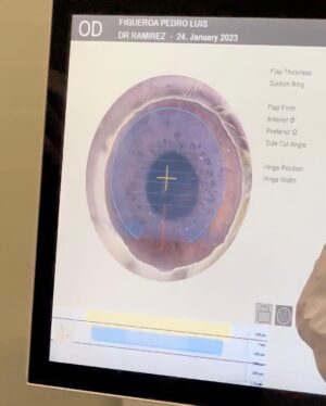 Pedro Figueira Instagram - MI PRIMERA OPERACIÓN! 👁️🫣 Apenas puedo ver el teléfono de vuelta y les admito que me operé la vista por fin :’) tenía demasiadas ganas de hacérmelo desde hace muchos años y ya tengo la edad de ser candidato a la operación. Obviamente me dio demasiado nervios porque ajá mrk es EL OJO y ayer casi pensé que me iba a quedar ciego pero gracias a dios todo salió súper bien, no me dolió nada de nada al momento. La recuperación si fue un día de lágrimas y dolor y hasta pensé que me iba a quedar así (veía demasiado borroso) pero ya hoy como nueva. Llevo desde los 12 utilizando lentes y no puedo creer que ya puedo ver bien tan inmediatamente 🫡 #lasik SE LAS RECOMIENDO 🤞🏼