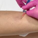 Sandra Parmová Instagram - Jestli máte rádi okamžitý zkrášlovací WOW efekt, mrkněte do galerie 💉🙀 Na sklerotizaci, tedy “vymizíkování” křečových žil jsem už byla, ale někdy to bývá trochu boj s větrnými mlýny😝 A zrovna u mě bylo potřeba zákrok zopakovat, protože metličkové žilky vypadaly tak trochu jako modřiny 🙈 Pokud na křečové žíly také trpíte, teď v zimě je nejlepší období to pořešit, protože je pak potřeba ještě 4 týdny nosit kompresní punčošky☺️ Ale to se zrovna v tomhle počasí dost hodí ❄️🌡️😅 A za ty krásné nožky to stojí 💃🏼🤩 Děkuji opět za skvělou péči, @medicomclinic. Možná se to z videí nezdá, ale rozhodně to nějak dramaticky nebolí. Jen to trochu štípne 💉😉 A paní doktorka @sabina.sellner umí trefit opravdu i tak drobné žilky, že jsem tomu ani sama nevěřila😍 Kdyby vás cokoliv zajímalo, klidně se v komentářích zeptejte. Můžeme tady sdílet třeba i vaše zkušenosti. ❤️ #krecovezily #zily #sklerotizace #medicomclinic #brno #vinicni #medicomgirl #letoseblizi #nejlepsizmenyjsoutyklepsimu #krasnenohy Brno, Czech Republic