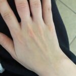 Sasha Clements Instagram - It’s easy to forget our progress! I documented my entire flare up just so I'd have references to look back on and i’m so happy I did! I couldn’t fit this ring on for almost a year (I tried every day). ⁠ ⁠ This week has presented some tough challenges and even though my fingers are still sore and I can see where I’m still swollen, I’m beyond grateful for the reminder that there has been improvement!🙏🏼⁠ ⁠ A little background- I was diagnosed with RA over 10 years ago. Was treated with Methotrexate and went into “remission”. Meaning my swelling and severe pain went down but I never really got better. I was still achy & sore. Had major brain fog & exhaustion to the point Corbin made me test for narcolepsy. I was always dealing with inflammation/ infections. I was constantly breaking out into rashes and hives and would be on Prednisone multiple times a year. So I was in "remission" but I wasn’t thriving - I was surviving. ⁠ ⁠ When I flared up again I was once again diagnosed with RA - then Lupus - then they added Lyme. With more testing we found I had high levels of mercury & lead, high toxic exposure, activated EBV, major vitamin deficiencies, hormonal imbalances, and mitochondrial dysfunction. ⁠ ⁠ I’ve been on a few different meds all with their lovely side effects🙄 Some have helped but I didn’t want to repeat the same pattern of just putting this bandaid on the pain. So here are some other things that have helped immensely!⁠ ⁠ -Working with a functional medicine doctor & getting testing done though them. Finding a mentor to guide me. I eat ZERO processed food, sugar, gluten, dairy, legumes, nuts, caffeine. I cook all of my food at home. I’ve tried many diets - AIP, low salicylate, carnivore, paleo, vegan, pescatarian and I found the trick is to just create your own diet prescription- your body knows what it needs. I take a rainbow of supplements, upped my water intake, practice gratitude, meditation, food combining, hot & cold therapy (sauna & cold showers), fasting, breath work, stretching, exercise, juicing, a wind down routine, & get good sleep.⁠ ⁠ It's a lot and wasn't achieved overnight but each layer you add will only get you closer to healing ❤️⁠ ⁠