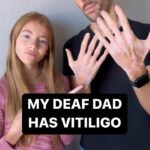 Shaylee Mansfield Instagram - Real talk… my Deaf dad has vitiligo and we had a chat about his journey. Vitiligo or not. Deaf or not. Or whatever it is. It’s time to embrace people of all kinds. 💜✨ Los Angeles, California