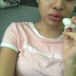 Urfi Javed Instagram - Just clarifying to these pictures are from 2016-2017 , not current Sharing with you all my lip filler journey I’ve been getting lip fillers from the age of 18 , I didn’t have that much money back then but I always felt my lips were too thin and I wanted bigger fuller lips . I went to dermat deni we’re ready to do it for less and these were the results at times ! I had to get them dissolved and mind it it’s the most painful thing ever !! I’m not telling people to not get them but Infact what I’m trying to say is just be careful while getting fillers or Botox . I still very much have lip fillers just that I know what suits my face and I know now less is more . Encouraging everyone to throughly research before going to any doctor . I actually revvokend fillers to everyone , if you have some insecurities about your face or body instead of hating yourself or your face it’s just better to opt for fillers or surgeries but but but from a very good doctor only.