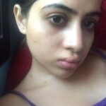 Urfi Javed Instagram - Just clarifying to these pictures are from 2016-2017 , not current Sharing with you all my lip filler journey I’ve been getting lip fillers from the age of 18 , I didn’t have that much money back then but I always felt my lips were too thin and I wanted bigger fuller lips . I went to dermat deni we’re ready to do it for less and these were the results at times ! I had to get them dissolved and mind it it’s the most painful thing ever !! I’m not telling people to not get them but Infact what I’m trying to say is just be careful while getting fillers or Botox . I still very much have lip fillers just that I know what suits my face and I know now less is more . Encouraging everyone to throughly research before going to any doctor . I actually revvokend fillers to everyone , if you have some insecurities about your face or body instead of hating yourself or your face it’s just better to opt for fillers or surgeries but but but from a very good doctor only.