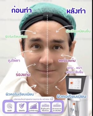 Willie McIntosh Instagram - วันหยุดแบบนี้ ผมก็รีบมาที่ ‘นฤชล คลินิก’ ทันที 
เพราะทางคลินิกมีนวัตกรรมน้องใหม่ล่าสุด Oligio 
ทั้งไม่ร้อน ไม่เจ็บ แล้วยังเห็นผลทันทีอีกด้วย
สบายผิวหน้า รู้สึกหน้ายกกระชับตึงขึ้นเลยครับ

สอบถามรายละเอียดเพิ่มเติมหรือนัดหมาย
Line OA : https://lin.ee/6nE3wOA
Facebook : https://www.facebook.com/naruchonclinic.center/
Instagram : https://www.instagram.com/naruchon_clinic/

#naruchonclinic #naruchonclinic💉 #นฤชลคลินิก #คลินิกความงาม #คลินิกเสริมความงาม #คลินิกรักษาสิว #ตึงกระชับ #ลดริ้วรอย #ผิวเรียบเนียนใส #ร้อยไหมอิตาลี #botoxthailand #ยกกระชับ #กระตุ้นคอลลาเจน #ฉีดคอลลาเจน #ฉีดวิตามินผิว  #ฉีดโบท็อก #ฉีดหน้าเรียว #ยกกระชับหน้าเรียว #ยกกระชับผิวหน้า #ปรับรูปหน้า #oligio #oligiothailand #oligiolifting