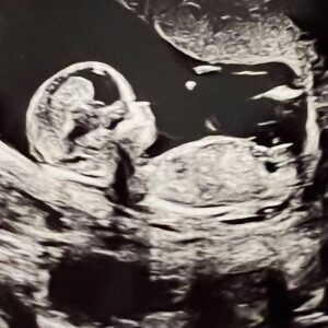 Alastair Aiken Instagram - We’re super excited to announce we’re pregnant! ❤️ Our newest lil family member will be joining us in October this year, and we couldn’t be happier 🥰❤️ These pictures were taken on our honeymoon earlier this year, but we’ve held off announcing until now. We’re over 24 weeks along, and you can see videos and pics from all our scans in the link in the bio! 👶🏼🍼