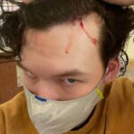 Devin Druid Instagram - 5 stitches later