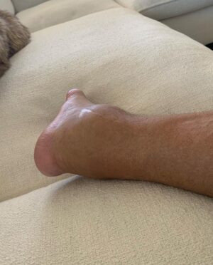 Dolph Lundgren Instagram - Finally doing surgery on my left ankle. I’ve had this injury since my time in the military. During 40 years of martial arts and doing action films, it’s been a fight  every day. The joint is now basically destroyed. Directing and starring in Wanted Man really did it in…Can’t wait to be able to walk normally again. 🙏👌👊 Will keep you posted.