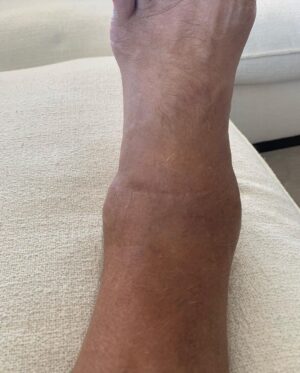 Dolph Lundgren Instagram - Finally doing surgery on my left ankle. I’ve had this injury since my time in the military. During 40 years of martial arts and doing action films, it’s been a fight  every day. The joint is now basically destroyed. Directing and starring in Wanted Man really did it in…Can’t wait to be able to walk normally again. 🙏👌👊 Will keep you posted.
