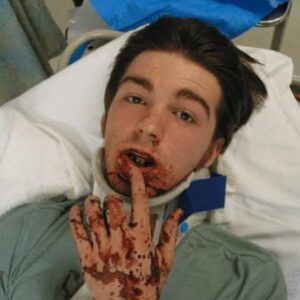Drake Bell Instagram - New music video for my song “I Kind Of Relate” is out tonight. For those who might not get some of the references in the video. This was my car accident. I was stopped at a red light and someone fell asleep at the wheel and hit me head on at about 60 mph. I broke my jaw in three places fractured my neck and lost 9 teeth. My jaw was wired shut for six months. Luckily I was driving a 1966 Ford Mustang and the strength of the car kept it from crushing in on me saving my life.