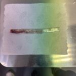 Hafþór Júlíus Björnsson Instagram - WARNING GRAPHIC SURGERY FOOTAGE. Live on my YouTube channel. Wednesday I’m 4 weeks post surgery. Sadly I got an infection 5 days ago resulting in an abscess and had to have a drainage tube inserted. Finally had that removed today. Swipe to see the length of it! 🤯