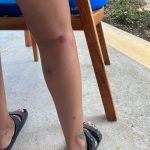 Jade Thirlwall Instagram – Turns out Jamaican mosquitos love biting me just as much as all the others 🥹🥰😏