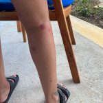 Jade Thirlwall Instagram - Turns out Jamaican mosquitos love biting me just as much as all the others 🥹🥰😏