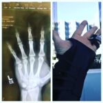 Johnny Galecki Instagram - Not the worst day but could have been better. Thanks to those at Cedar-Sinai Medical. #youshouldseetheotherguy
