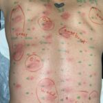 Johnny Knoxville Instagram - Got an allergy test yesterday for the first time in 15 years. Looks like nothing has changed!🤪🤣