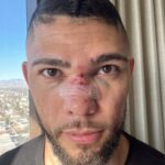 Johnny Walker Instagram - 2 weeks after fight . Speed recovery from a broken nose ! Was it fast? Foi rápido a recuperação? 2 semanas : nariz quebrado