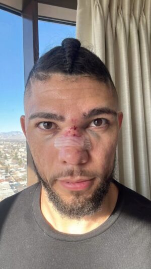 Johnny Walker Instagram - 2 weeks after fight . Speed recovery from a broken nose ! Was it fast?  Foi rápido a recuperação? 2 semanas : nariz quebrado