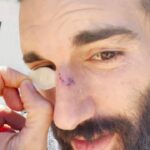Justin Baldoni Instagram - Quick PSA- I just had some Skin Cancer removed from my nose. This type of skin cancer, Basal cell carcinoma (not sarcoma) is super common, doesn't spread, and if caught early is easily treated and removed (so nothing to worry about, I'm great❤️🙏🏼) I am feeling super grateful I listened to my body and wanted to share with everyone as a reminder to protect your skin with MINERAL BASED sunscreen and get checked regularly. 🙌🏼