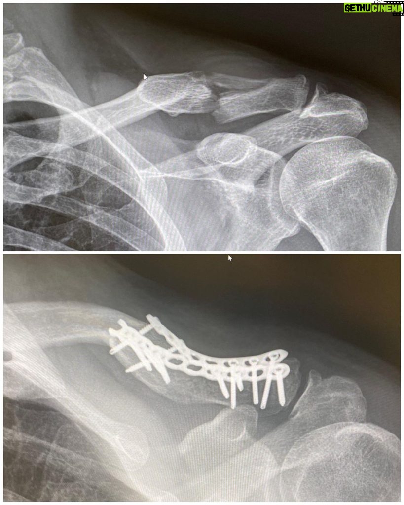 Steve-O Instagram - I’m about to go into surgery to remove two plates and a bunch of screws from my collarbone. Fun fact, today is exactly five years since the day I found @wendyfromperu on the streets of Peru (that’s her tattooed under my collarbone).