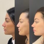 Gabrielle Prado Instagram - Tem tempo que tô pra postar esse antes e depois aqui das minhas cirurgias no nariz. mas hoje vou falar um pouquinho do processo! Outubro do ano passado fiz Septoplastia na @jkesteticaavancada devido a dificuldade que eu tinha de respirar e isso me atrapalhar muito no trabalho e no meu dia a dia (a clínica tem médicos profissionais excelentes que priorizam a sua saúde e lá foi o único local que me senti acolhida e confiante pra fazer esse procedimento). Depois de várias consultas, pedi ao Dr também que afinasse a ponta do meu nariz e desse uma empinada. ele fez maravilhosamente bem, só que eu não cumpri o pós e meu nariz acabou cedendo a ponta e inflamando muito. foi um processo longo (6 meses) de cuidados com a Jk e Abril desse ano refizemos a rino. Hoje, 2 meses depois esse é o resultado! não é o final, pq o Dr disse que pro resultado final, precisamos de 6 meses a 1 ano. no início confesso que foi difícil a adaptação, pq muda bastante, né? mesmo pq eu tenho brigado bastante com minha autoestima (depois falamos disso). só que hoje acordei e me olhei no espelho e me senti preparada pra compartilhar algo que tem sido bastante comentado por aqui. conforme os meses forem passando, eu vou mostrando a evolução pra vocês, ok? Qualquer dúvida só chamar o pessoal da @jkesteticaavancada beijo, mamãe ama! 💜 São Paulo, Brazil