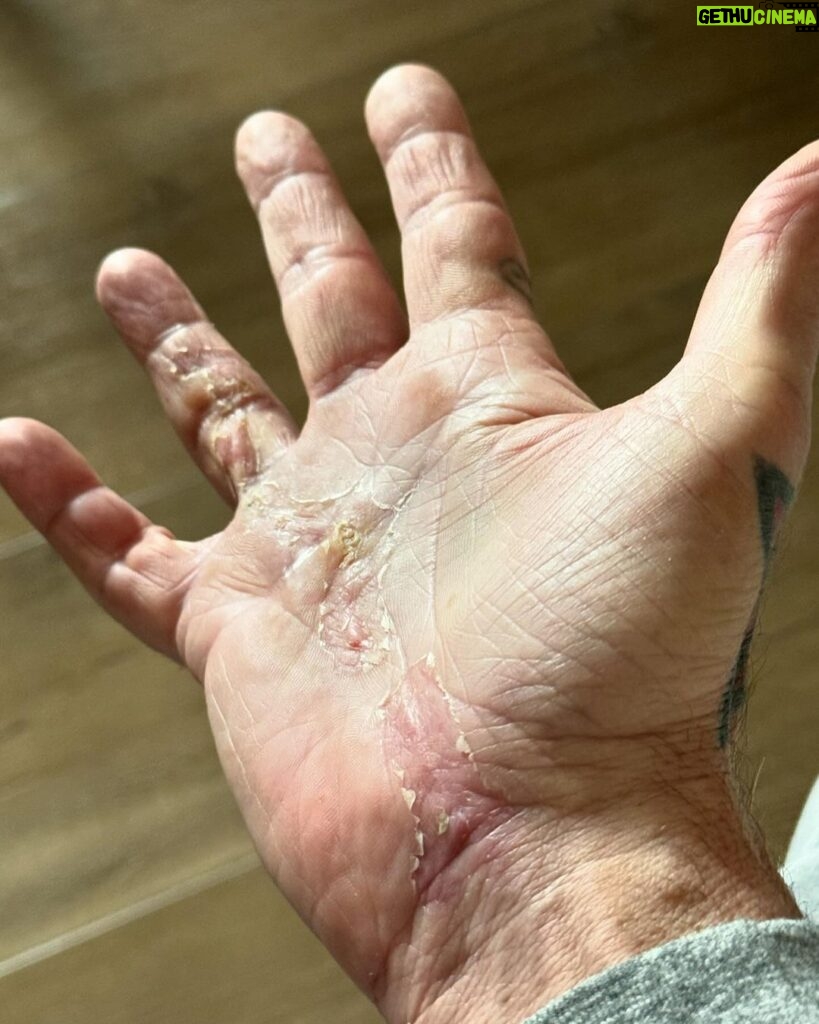 Tommy Lee Instagram - 5 weeks ago today surgery was done! 🙌🏼ealing 🙌🏼ands 🙌🏼ero @drcohenhandsurgeon