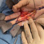 Tommy Lee Instagram - Well kids, it’s show n tell time… hope this doesn’t wreck your lunch 😂 only 3 weeks ago i underwent a hand surgery by @drcohenhandsurgeon He addressed 2 debilitating issues for me as a drummer, keyboard player and pretty much everything to do with my right hand. And yesterday was fucking monumental for me to the point of tears …. I have my life back and my money makers 🙌🏼 . And for you drummers and musicians out there i can say it’s possible to fix! And in the last clip I’m able to twirl my sticks again… i haven’t been able to do that in a few years because of the Dupytrens Contracture and carpal tunnel issues that are now gone! @drcohenhandsurgeon and the staff there I AM FOREVER GRATEFUL 🙏🏻