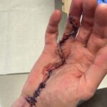 Tommy Lee Instagram - Well kids, it’s show n tell time… hope this doesn’t wreck your lunch 😂 only 3 weeks ago i underwent a hand surgery by @drcohenhandsurgeon He addressed 2 debilitating issues for me as a drummer, keyboard player and pretty much everything to do with my right hand. And yesterday was fucking monumental for me to the point of tears …. I have my life back and my money makers 🙌🏼 . And for you drummers and musicians out there i can say it’s possible to fix! And in the last clip I’m able to twirl my sticks again… i haven’t been able to do that in a few years because of the Dupytrens Contracture and carpal tunnel issues that are now gone! @drcohenhandsurgeon and the staff there I AM FOREVER GRATEFUL 🙏🏻