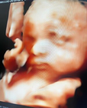 Diane Medina Instagram - 3D/4D of our Baby Girl at @babybondultrasound.ph 💖 Thank you so much @babybondultrasound.ph for accommodating us! Super happy nagpakita agad si Baby! Heheh Love you anak 🌸

To all the Preggy Mommas, you can have your Ultrasound Check up, Congenital Anomaly Scan, 3D/4D Live Ultrasound with Printed Scans and Frame just message @babybondultrasound.ph located at 3rd level of SM The Block 🌸